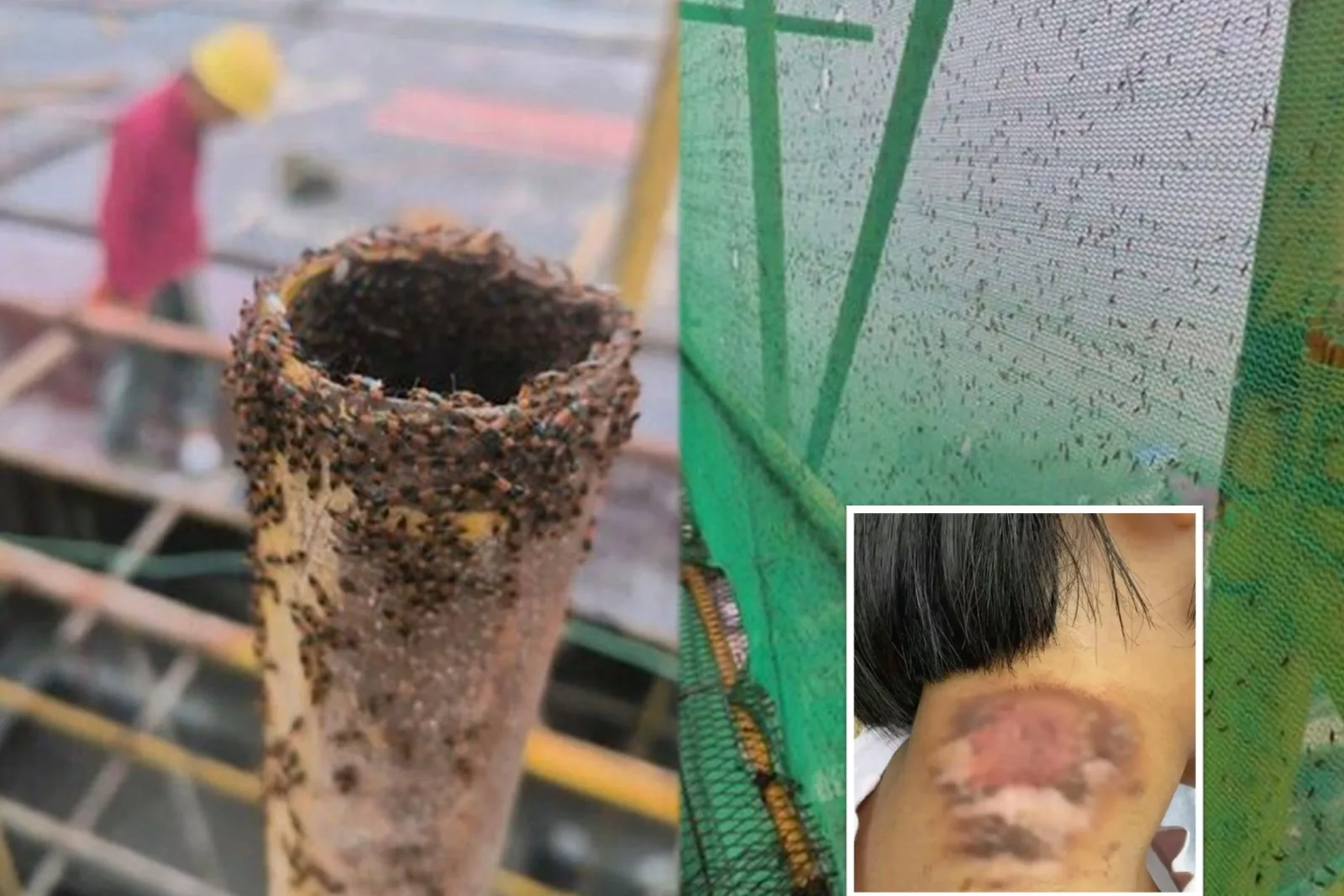 河南工地出現隱翅蟲，一名4歲女童頸部傷口一度潰爛20多天。（網路圖片合成）