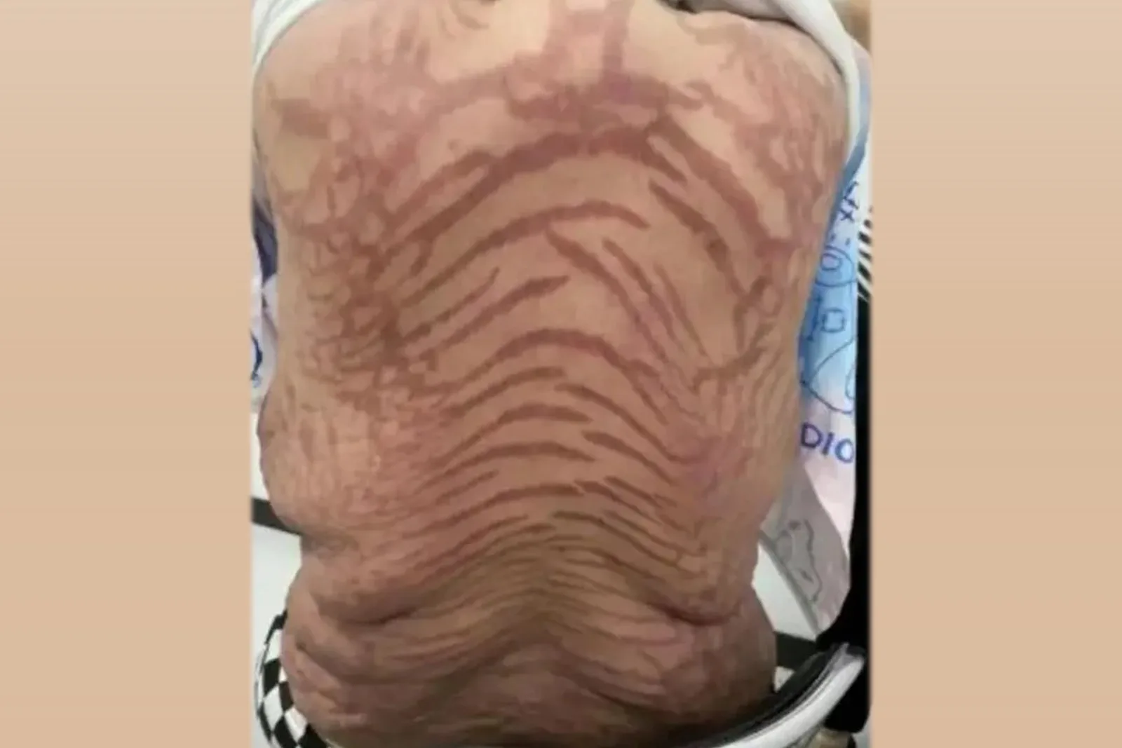 大陸一名40歲的女子因使用一款網紅藥膏長達十年，最終確診為「續發性腎上腺皮質功能減退」。（網路圖片）