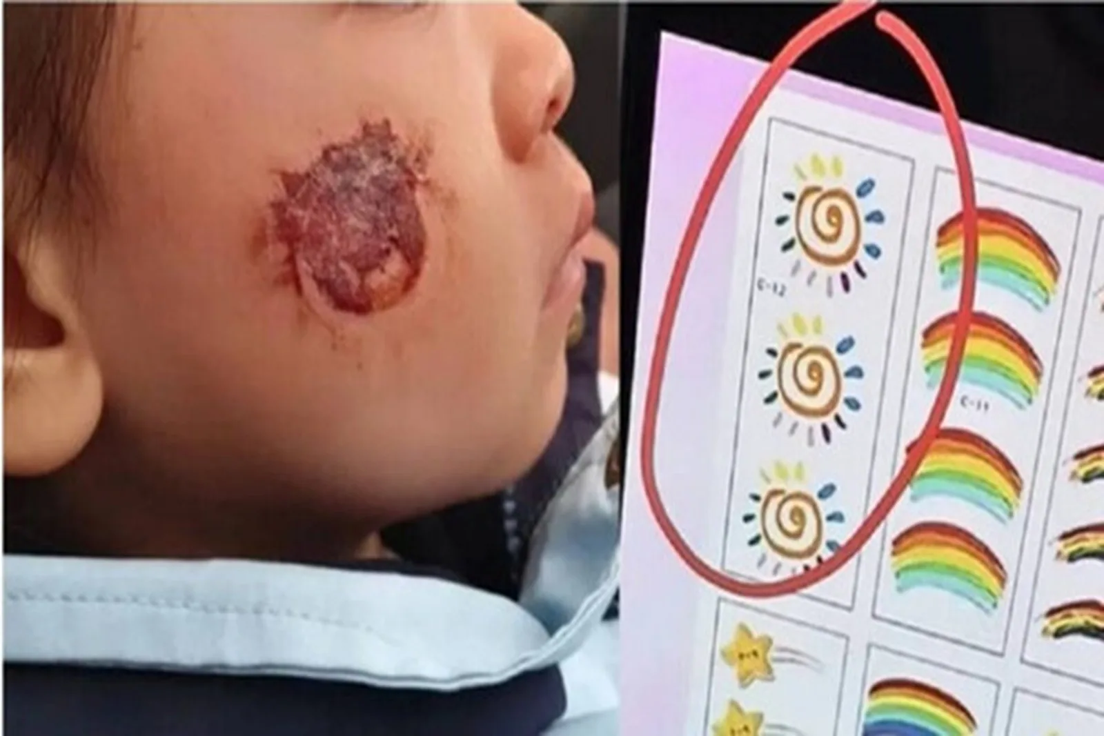 湖南三歲女童臉頰上貼了一張裝飾貼紙後，臉部紅腫、糜爛，被醫師確診為急性接觸性皮炎。（微博擷圖）
