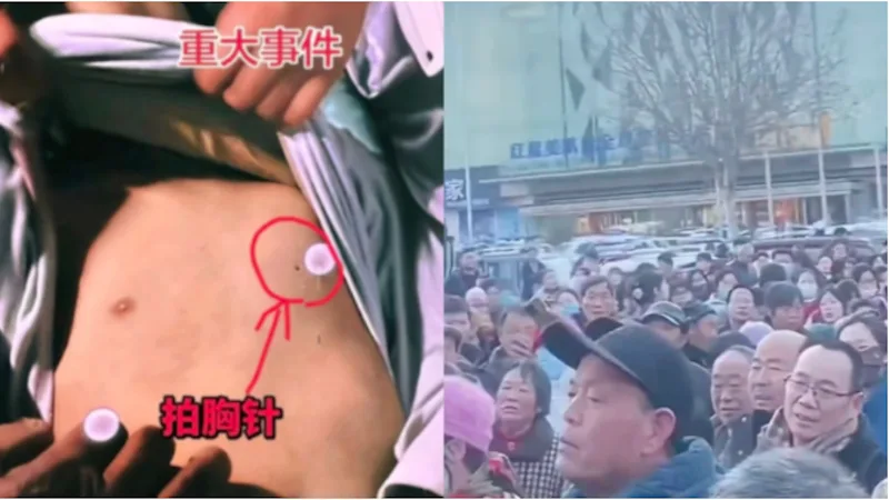 河南,离奇,死亡,新蔡县,器官,法医,尸检,心源性猝死,针孔