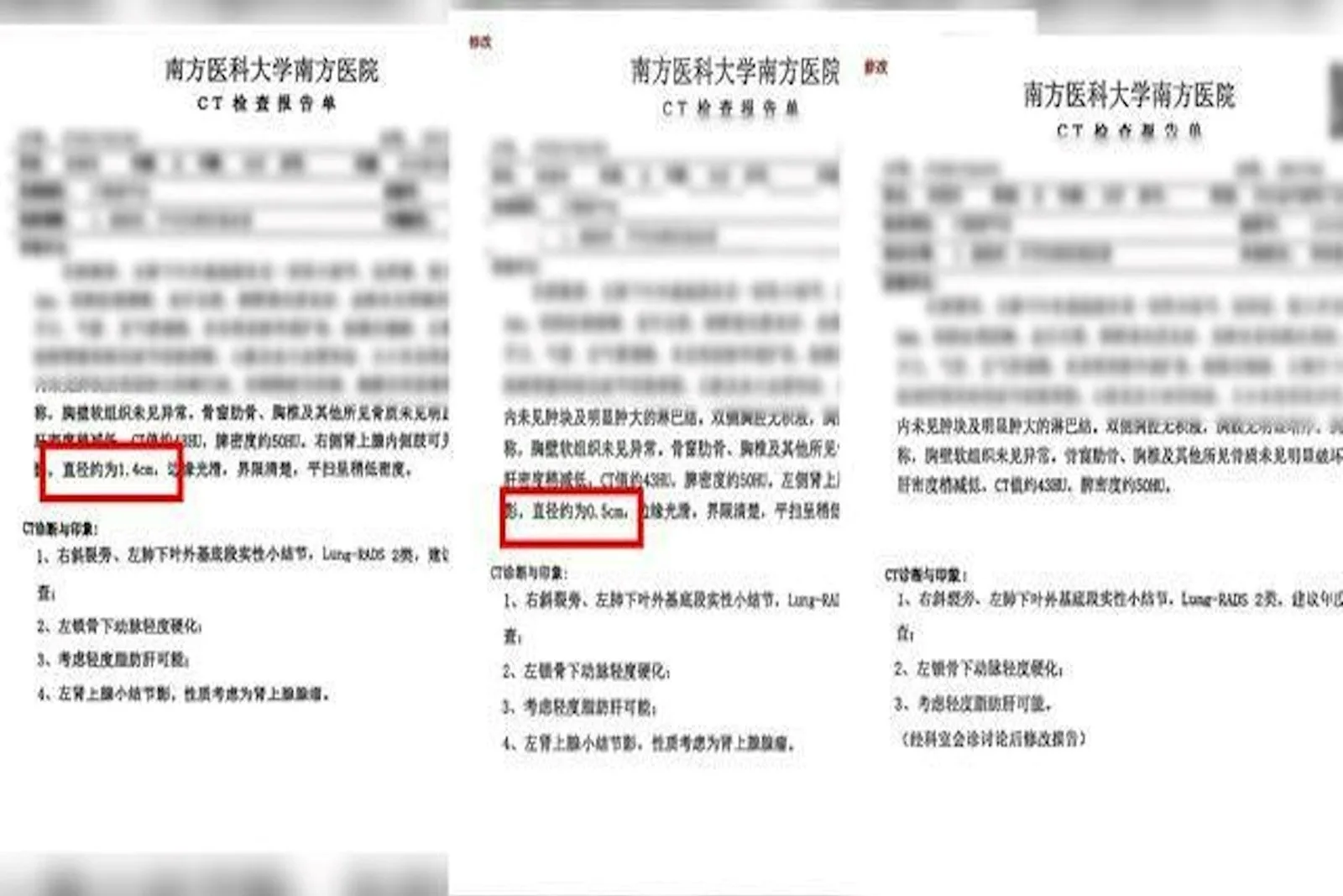 李女士去年底體檢，南方醫科大學南方醫院出具三份不同的CT報告。（網路圖片）